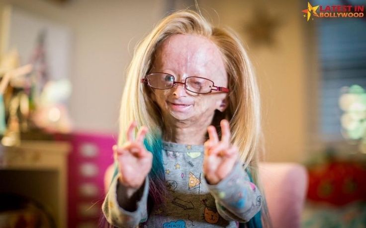 Adalia Rose Biography: Age, Net Worth, Parents, Siblings, Career, Wikipedia, Pictures