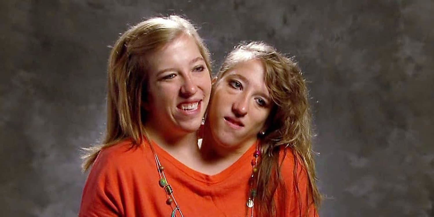 Meet conjoined twins Brittany and Abby Hensel